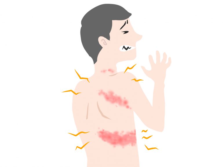 頭皮 帯状 疱疹 頭皮の帯状疱疹：症状、原因、治療、予防