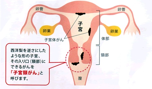 子宮頸がんとは？