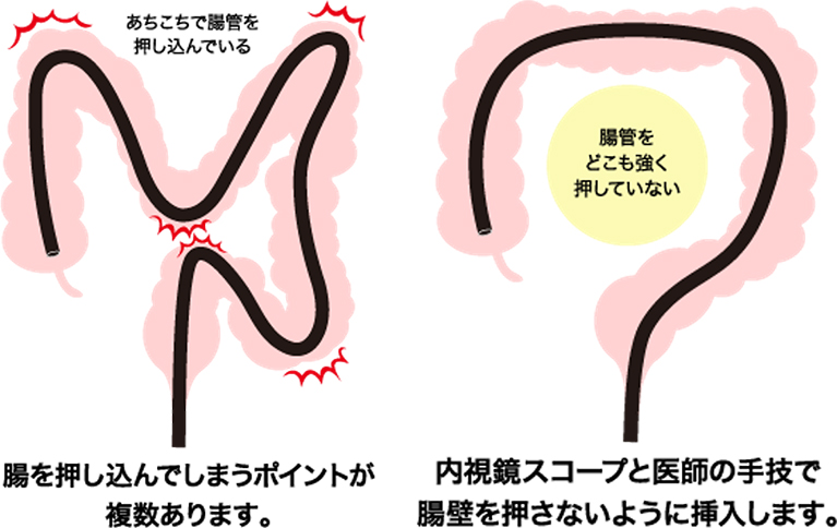 苦痛を軽減した軸保持短縮法