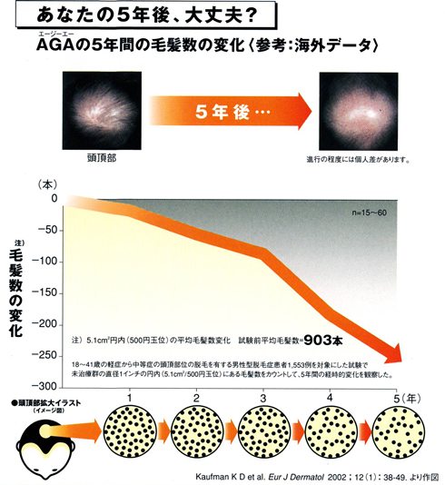 AGA（男性型脱毛症）