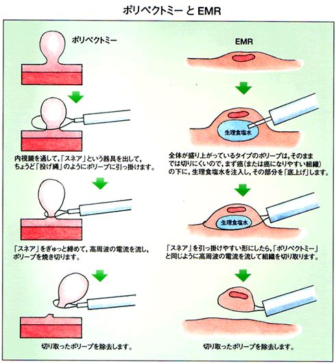 ポリペクトミーとEMR