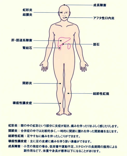 壊疽性膿皮症