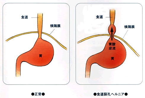 食道裂孔ヘルニアとは