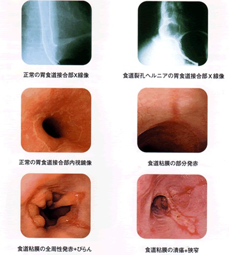 げっぷ 胃腸 炎